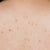 Chest and Back Acne