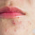 Acne-Prone Skin