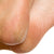 Callused Skin
