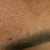 Skin Discoloration
